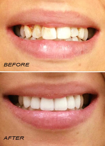 Before and after. German Dentist Marbella San Pedro