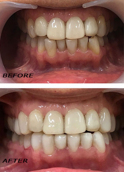 Before and after. Veneers Edelweiss in part below optimized with laser. German Dentist Marbella San Pedro