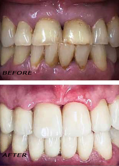 Before and after. Treatment with high quality ceramic crowns. German Dentist Marbella San Pedro