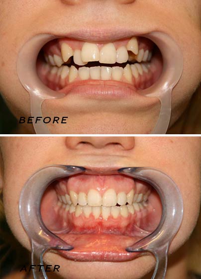 Before and after. Orthodontic treatment. German Dentist Marbella San Pedro