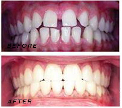 Before and after. Treatment with high tech ceramic veneers. German Dentist Marbella San Pedro