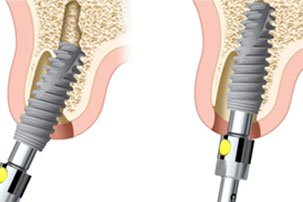 NobelActive Immediate Implant Implant Position. German Dentist Marbella, San Pedro