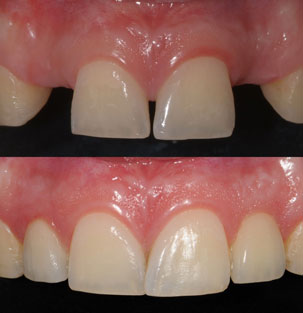 NobelActive Immediate Implant. Before After Anterior Restoration. German Dentist Marbella, San Pedro