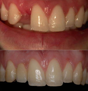 NobelActive Immediate Implant. Before After Restoration of upper lateral incisor. German Dentist Marbella, San Pedro
