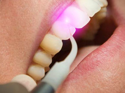 Dental treatments: Dental Laser German Dentist Marbella, San Pedro
