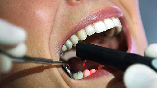 Tooth Extraction last option for dentists. Dentist Marbella Dr Hotz