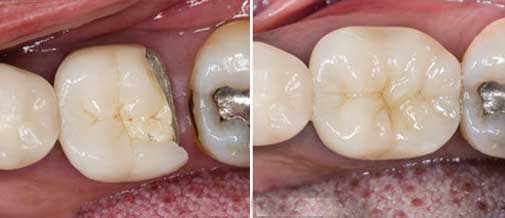 Dental Restoration Reconstruction with Dental Filling like Composite Fillings. Dentist Marbella Dr Hotz