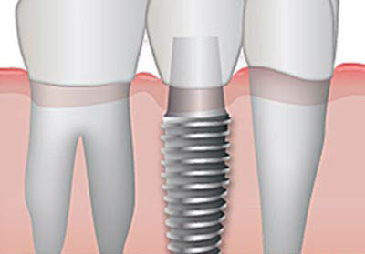 Immediate Loading Of Dental Implants. German Dentist Clinic Marbella San Pedro