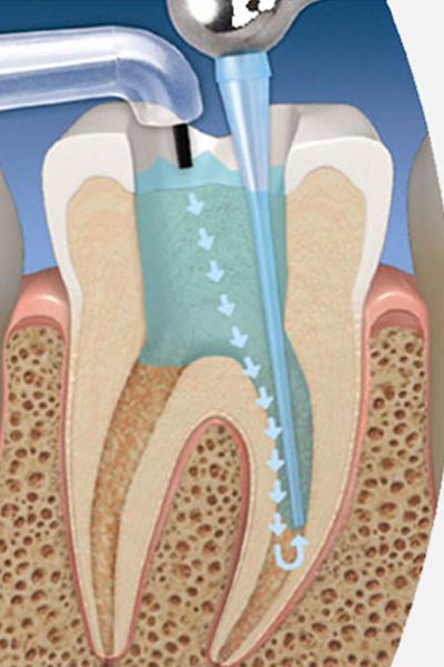 Root Canal Treatment with Laser. German Dentist Clinic Marbella San Pedro