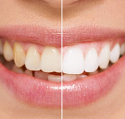 Dental Treatments Teeth Whitening Marbella San Pedro