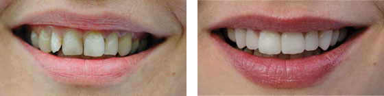 High Tech Ceramic Veneers before and after treatment. German Dentist Clinic Marbella San Pedro